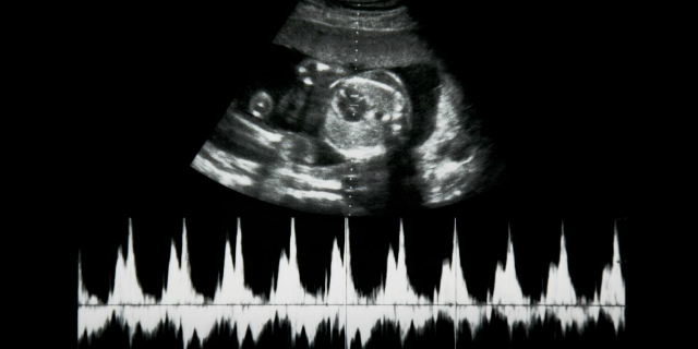 Obbligo di ascoltare il battito del feto: la petizione
